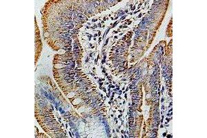 Immunohistochemical analysis of COX6B1 staining in human colon cancer formalin fixed paraffin embedded tissue section. (COX6B1 抗体)