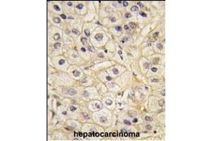 Formalin-fixed and paraffin-embedded human hepatocarcinoma tissue reacted with GRK1 Antibody (C-term) (ABIN390984 and ABIN2841167) , which was peroxidase-conjugated to the secondary antibody, followed by DAB staining. (GRK1 抗体  (C-Term))