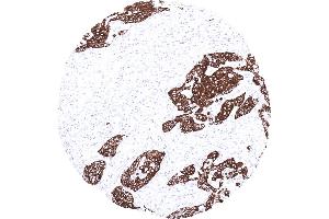 Strong cytokeratin 13 immunostaining in a squamous cell carcinoma of the oral cavity (Cytokeratin 13 抗体)