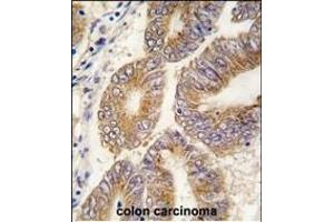 Formalin-fixed and paraffin-embedded human colon carcinoma tissue reacted with AHCY antibody (C-term) (ABIN389202 and ABIN2839362) , which was peroxidase-conjugated to the secondary antibody, followed by DAB staining. (AHCY 抗体  (C-Term))