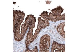 Immunohistochemical staining (Formalin-fixed paraffin-embedded sections) of human prostate cancer with EZR monoclonal antibody, clone CL2384  shows strong membranous and moderate cytoplasmic positivity in glandular cells.