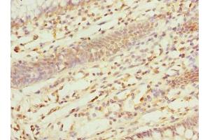 Immunohistochemistry of paraffin-embedded human colon cancer using ABIN7162554 at dilution of 1:100