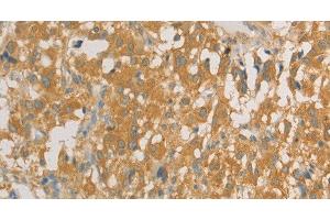 Immunohistochemistry of paraffin-embedded Human thyroid cancer tissue using PRPSAP1 Polyclonal Antibody at dilution 1:80 (PRPSAP1 抗体)