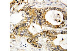 Anti-Annexin A3 antibody, IHC(P) IHC(P): Human Mammary Cancer Tissue (Annexin A3 抗体  (Middle Region))