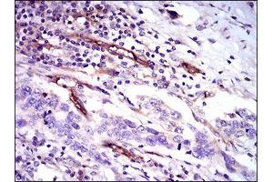Immunohistochemical analysis of paraffin-embedded esophageal cancer tissues using CD59 mouse mAb with DAB staining. (CD59 抗体  (AA 31-111))