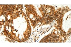 Immunohistochemistry of paraffin-embedded Human colon cancer using COX7B Polyclonal Antibody at dilution of 1:60 (COX7B 抗体)