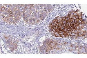 ABIN6279126 at 1/100 staining Human urothelial cancer tissue by IHC-P. (SLC4A2 抗体  (Internal Region))