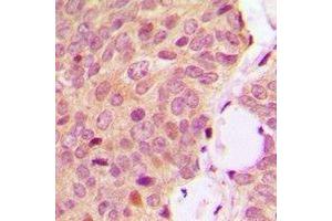 Immunohistochemical analysis of OMI staining in human breast cancer formalin fixed paraffin embedded tissue section. (HTRA2 抗体)