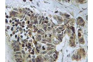 Immunohistochemistry analyzes of Caspase 9 antibody in paraffin-embedded human lung carcinoma tissue. (Caspase 9 抗体)