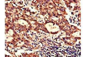 Immunohistochemistry of paraffin-embedded human lung cancer using ABIN7160929 at dilution of 1:100 (NDUFB6 抗体  (AA 2-67))