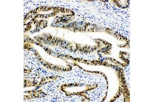 Anti-DUT antibody,  IHC(P) IHC(P): Human Intestinal Cancer Tissue (Deoxyuridine Triphosphatase (DUT) (AA 212-229), (C-Term) 抗体)