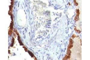 Formalin-fixed, paraffin-embedded human lung carcinoma stained with Cytokeratin 7 antibody (KRT7/760) (Cytokeratin 7 抗体)