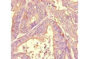 Immunohistochemistry of paraffin-embedded human endometrial cancer using ABIN7143790 at dilution of 1:100 (alpha 2 Macroglobulin 抗体  (AA 1216-1467))