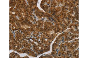 Immunohistochemistry of Human breast cancer using MRE11A Polyclonal Antibody at dilution of 1:60 (Mre11 抗体)