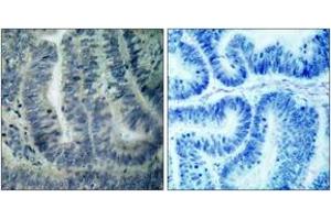 Immunohistochemistry analysis of paraffin-embedded human colon carcinoma tissue, using BAD (Ab-112) Antibody. (BAD 抗体  (AA 78-127))