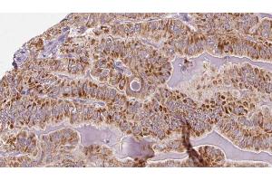 ABIN6273318 at 1/100 staining Human thyroid cancer tissue by IHC-P.