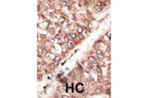 Formalin-fixed and paraffin-embedded human cancer tissue reacted with the primary antibody, which was peroxidase-conjugated to the secondary antibody, followed by AEC staining. (BMP3 抗体  (N-Term))