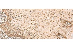 Immunohistochemistry of paraffin-embedded Human esophagus cancer tissue using BAP1 Polyclonal Antibody at dilution of 1:35(x200) (BAP1 抗体)