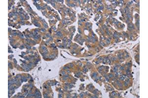 The image on the left is immunohistochemistry of paraffin-embedded Human ovarian cancer tissue using ABIN7191790(PARP4 Antibody) at dilution 1/20, on the right is treated with synthetic peptide. (PARP4 抗体)