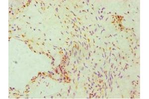Immunohistochemistry of paraffin-embedded human cervical cancer using ABIN7162842 at dilution of 1:100 (FKBP4 抗体  (AA 220-459))