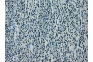 Immunohistochemical staining of paraffin-embedded Carcinoma of bladder tissue using anti-PRKYmouse monoclonal antibody. (PRKY 抗体)