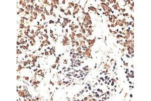 Immunohistochemistry of paraffin-embedded Human lung cancer using MCM5 Polyclonal Antibody at dilution of 1:100 (40x lens). (MCM5 抗体)