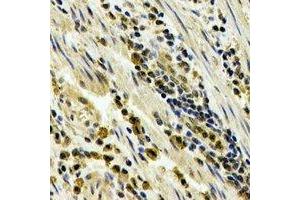 Immunohistochemical analysis of STAU1 staining in human esophageal cancer formalin fixed paraffin embedded tissue section. (STAU1/Staufen 抗体)