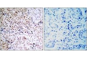 Immunohistochemistry analysis of paraffin-embedded human breast carcinoma, using Retinoblastoma (Phospho-Ser795) Antibody. (Retinoblastoma Protein (Rb) 抗体  (pSer795))