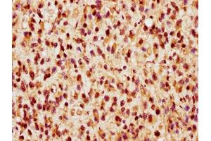 IHC image of ABIN7172411 diluted at 1:300 and staining in paraffin-embedded human glioma performed on a Leica BondTM system. (VGLL1 抗体  (AA 139-250))