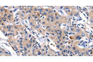 Immunohistochemistry of paraffin-embedded Human lung cancer tissue using MMP16 Polyclonal Antibody at dilution 1:40 (MMP16 抗体)