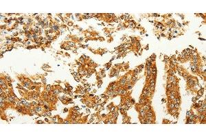 Immunohistochemistry of paraffin-embedded Human gastric cancer tissue using FZD6 Polyclonal Antibody at dilution 1:60 (FZD6 抗体)