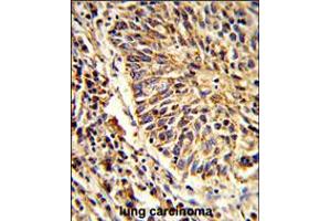 Formalin-fixed and paraffin-embedded human lung carcinoma reacted with ADAM9 Antibody , which was peroxidase-conjugated to the secondary antibody, followed by DAB staining. (ADAM9 抗体  (C-Term))
