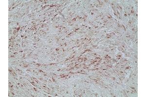 Immunohistochemistry analysis of human melanoma skin tissue using Melanoma marker (human) mAb (HMB45) (Ready-To-Use), (ABIN7211671). (Melanoma Marker 抗体)