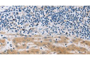 Immunohistochemistry of paraffin-embedded Human liver cancer using MUC20 Polyclonal Antibody at dilution of 1:40 (MUC20 抗体)