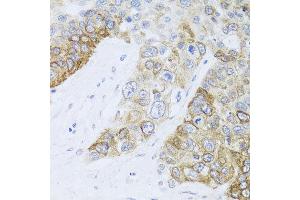 Immunohistochemistry of paraffin-embedded human lung cancer using CHD1 antibody at dilution of 1:100 (x40 lens). (CHD1 抗体)