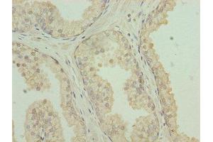 Immunohistochemistry of paraffin-embedded human prostate cancer using ABIN7146065 at dilution of 1:100 (CLEC3A 抗体  (AA 23-197))
