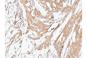 Formalin-fixed, paraffin-embedded human leiomyosarcoma stained with pan Muscle Actin antibody (Pan Muscle Actin 抗体)