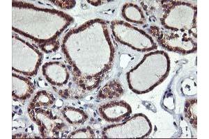 Immunohistochemical staining of paraffin-embedded Carcinoma of Human thyroid tissue using anti-ALG2 mouse monoclonal antibody. (ALG2 抗体)