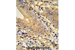 Formalin-fixed and paraffin-embedded human colon carcinoma reacted with TSPAN33 Antibody (C-term), which was peroxidase-conjugated to the secondary antibody, followed by DAB staining. (TSPAN33 抗体  (C-Term))