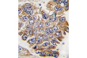 Formalin-fixed and paraffin-embedded human lung carcinoma tissue reacted with GRB2 Antibody , which was peroxidase-conjugated to the secondary antibody, followed by DAB staining. (GRB2 抗体  (AA 187-216))