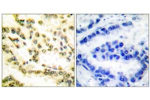 Immunohistochemical analysis of paraffin-embedded human lung carcinoma tissue, using Lamin A (cleaved-Asp230) antibody. (Lamin A/C 抗体  (Cleaved-Asp230, Internal Region))