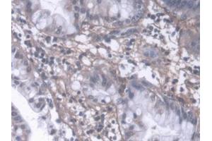DAB staining on IHC-P; Samples: Human Liver cancer Tissue (PIIINP 抗体  (AA 24-153))