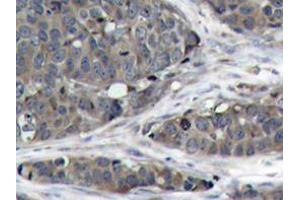 Immunohistochemistry analysis of NFκB-p105/p50 antibody in paraffin-embedded human breast carcinoma tissue. (NFKB1 抗体)