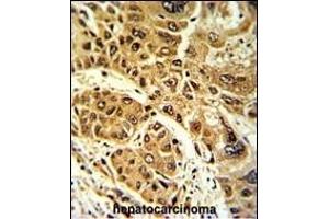 Formalin-fixed and paraffin-embedded human hepatocarcinoma with LPIN2 Antibody (Center), which was peroxidase-conjugated to the secondary antibody, followed by DAB staining. (Lipin 2 抗体  (AA 262-288))