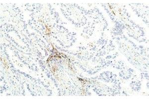Immunohistochemistry of paraffin-embedded Human lung carcinoma tissue using JAK1 Monoclonal Antibody at dilution of 1:200. (JAK1 抗体)