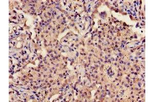 Immunohistochemistry of paraffin-embedded human lung cancer using ABIN7163589 at dilution of 1:100 (CD42a 抗体  (AA 17-88))
