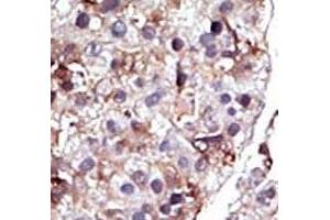 IHC analysis of FFPE human hepatocarcinoma tissue stained with the SPHK2 antibody (SPHK2 抗体  (AA 1-30))