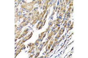 Immunohistochemistry of paraffin-embedded human liver cancer using IKBKAP Rabbit pAb (ABIN6130369, ABIN6142278, ABIN6142279 and ABIN6214265) at dilution of 1:100 (40x lens). (IKAP/p150 抗体  (AA 1093-1332))