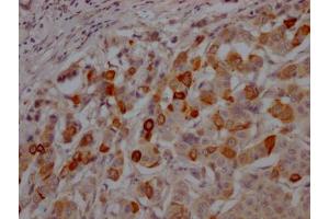 IHC image of  diluted at 1:100 and staining in paraffin-embedded human breast cancer performed on a Leica BondTM system. (Recombinant GSK3 beta 抗体)
