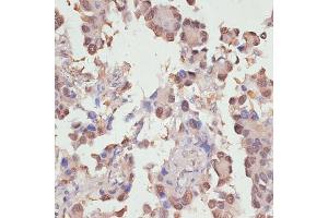 Immunohistochemistry of paraffin-embedded human lung cancer using Y antibody (ABIN6132789, ABIN6150317, ABIN6150322 and ABIN6215136) at dilution of 1:100 (40x lens). (YAP1 抗体  (AA 155-504))